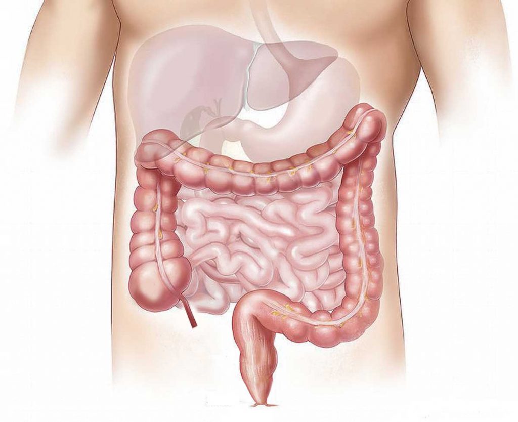 síndrome del intestino permeable: